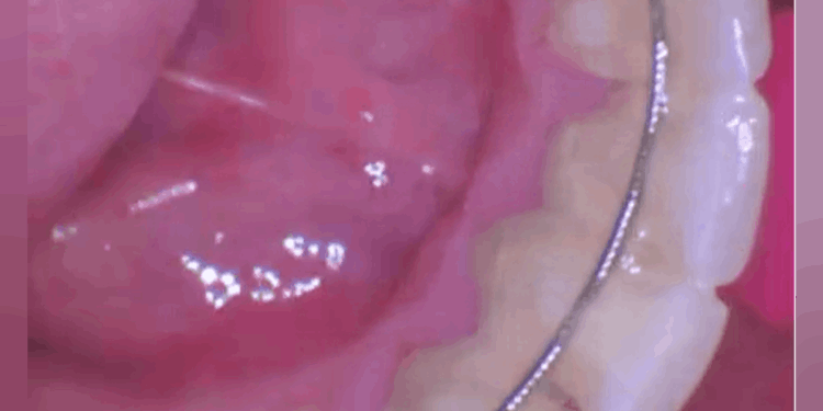 歯茎の健康を再生：グリシンベースのエアポリッシングを用いたSRPのケーススタディ