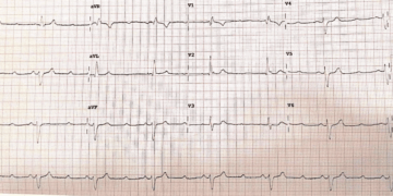 パラセタモール過剰摂取による心臓伝導障害：稀な症例