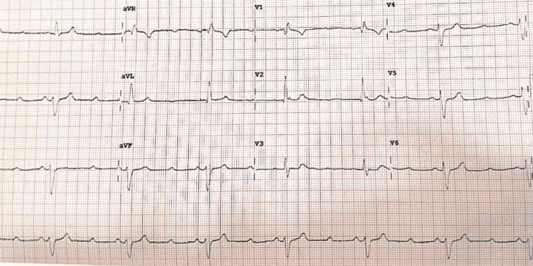 パラセタモール過剰摂取による心臓伝導障害：稀な症例