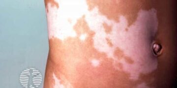 パイロット研究:白斑治療における補助療法としての経口NACの効果を検証