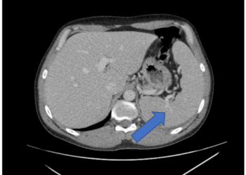 エプスタイン・バーウイルス（EBV）肝炎に対するN-アセチルシステイン治療：プラセボ効果と真の効果の比較