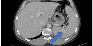 エプスタイン・バーウイルス（EBV）肝炎に対するN-アセチルシステイン治療：プラセボ効果と真の効果の比較