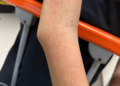 Severe Dengue-Associated Hepatitis in an Adolescent Treated With Oral Acetylcysteine: A Case Report