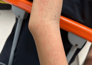Severe Dengue-Associated Hepatitis in an Adolescent Treated With Oral Acetylcysteine: A Case Report