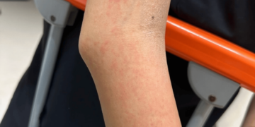 Severe Dengue-Associated Hepatitis in an Adolescent Treated With Oral Acetylcysteine: A Case Report